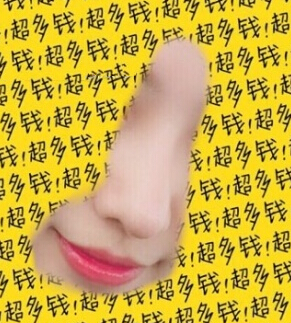 上海伯思立顾清医生做的半肋软骨隆鼻