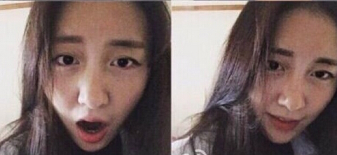 娇点李竞医生做的水动力大腿环吸手术案例