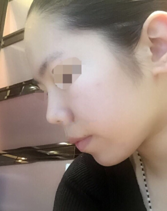注射玻尿酸和注射瘦脸带来的变化