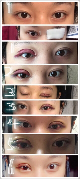 上海九院王琛医生修复双眼皮开眼角果