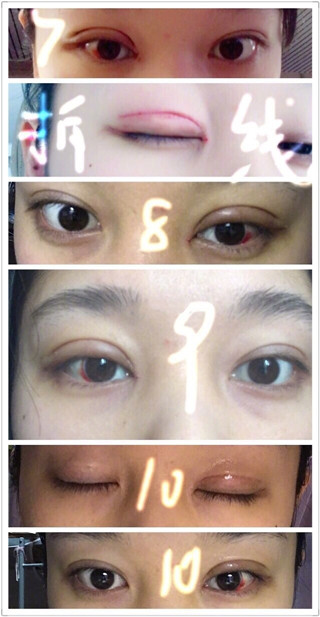 上海九院王琛医生修复双眼皮开眼角果