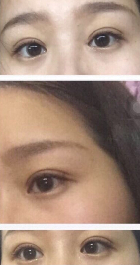 温州附一医老医院潘主任做的双眼皮手术