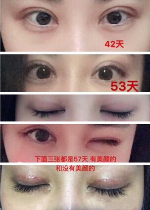 长沙艺星整形美容医院做的全切双眼皮手术