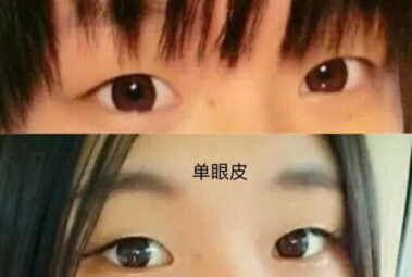 双眼皮几乎没有了,求推荐修复医生