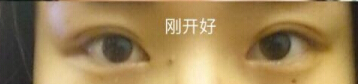 双眼皮几乎没有了,求推荐修复医生