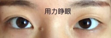 双眼皮几乎没有了,求推荐修复医生