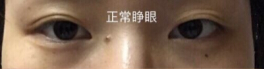 双眼皮几乎没有了,求推荐修复医生