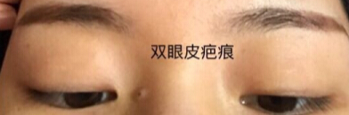 双眼皮几乎没有了,求推荐修复医生
