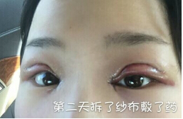 江苏省中医院陈刚医生双眼皮开眼角提肌案例