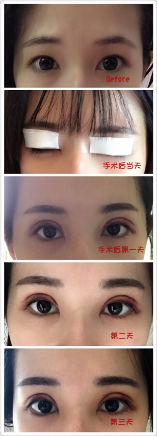 珠海科美张民望做双眼皮手术果好吗？