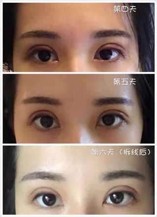 珠海科美张民望做双眼皮手术果好吗？