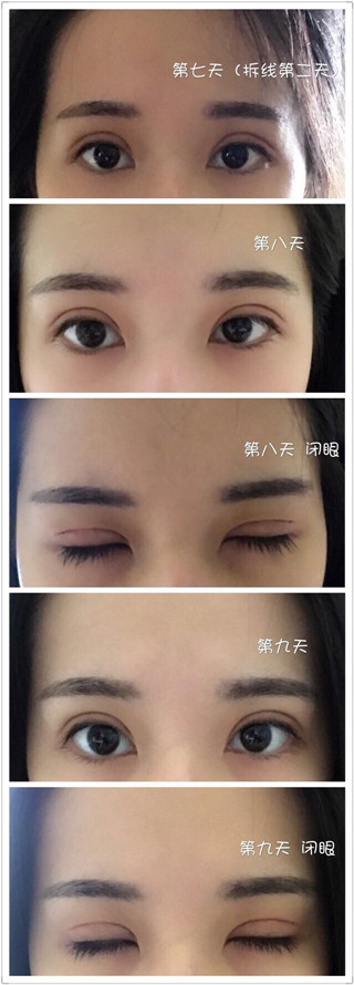 珠海科美张民望做双眼皮手术果好吗？