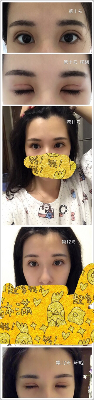 珠海科美张民望做双眼皮手术果好吗？