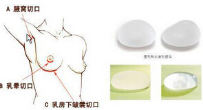 假体丰胸手术会有后遗症吗?