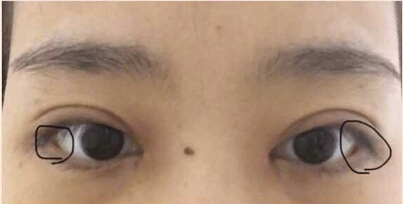 广州美莱做的双眼皮开眼角提肌果怎么样？