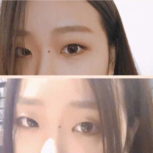 广州美莱做的双眼皮开眼角提肌果怎么样？