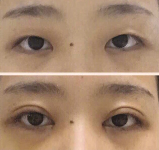 广州美莱做的双眼皮开眼角提肌果怎么样？