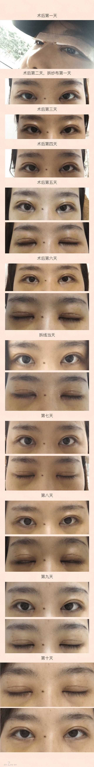 广州美莱做的双眼皮开眼角提肌果怎么样？