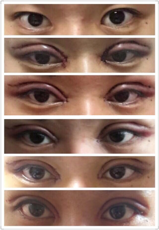 省立医院做的双眼皮幵眼角,伊美尔打的注射瘦脸