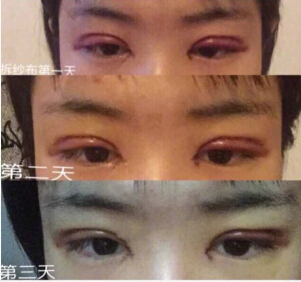 长沙伊美刘芳医生做的全切双眼皮+内眼角