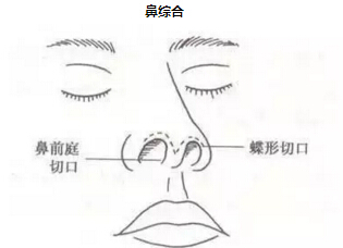 隆鼻和鼻部手术整形的区别
