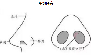 隆鼻和鼻部手术整形的区别