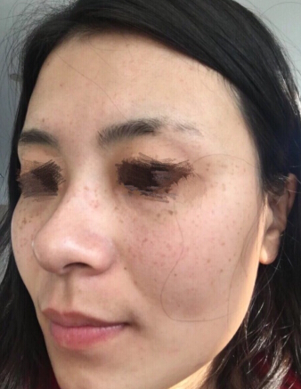 上海华山医院激光祛遗传性雀斑怎么样?