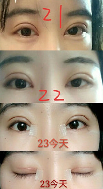 武汉中翰李哲处医生做的双眼皮、内眼角