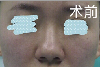 重医张劲医生处做的埋线提升鼻修复鼻部手术
