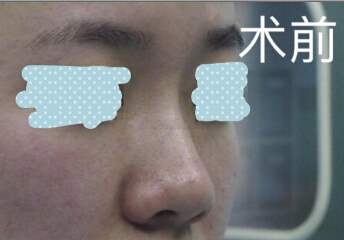 重医张劲医生处做的埋线提升鼻修复鼻部手术