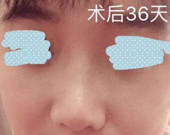 重医张劲医生处做的埋线提升鼻修复鼻部手术