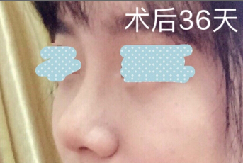 重医张劲医生处做的埋线提升鼻修复鼻部手术