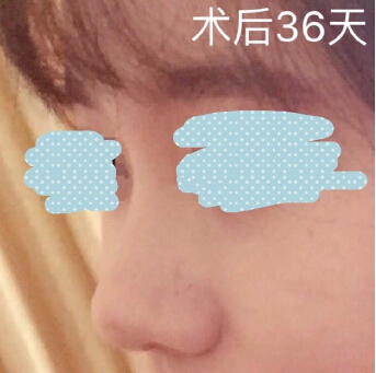 重医张劲医生处做的埋线提升鼻修复鼻部手术