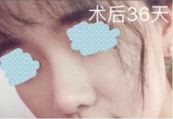 重医张劲医生处做的埋线提升鼻修复鼻部手术