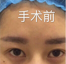 郑州金水周鹏飞医疗美容做的眼部手术修复