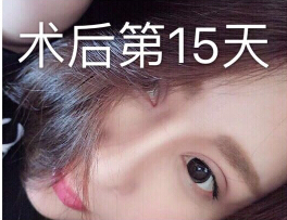 郑州金水周鹏飞医疗美容做的眼部手术修复
