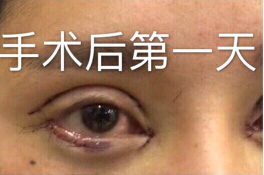 郑州金水周鹏飞医疗美容做的眼部手术修复