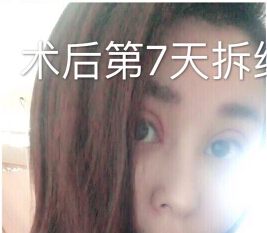 郑州金水周鹏飞医疗美容做的眼部手术修复