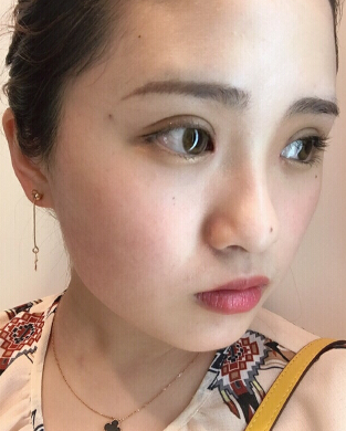 南京省中医院刘宁医生做的双眼皮内眼角