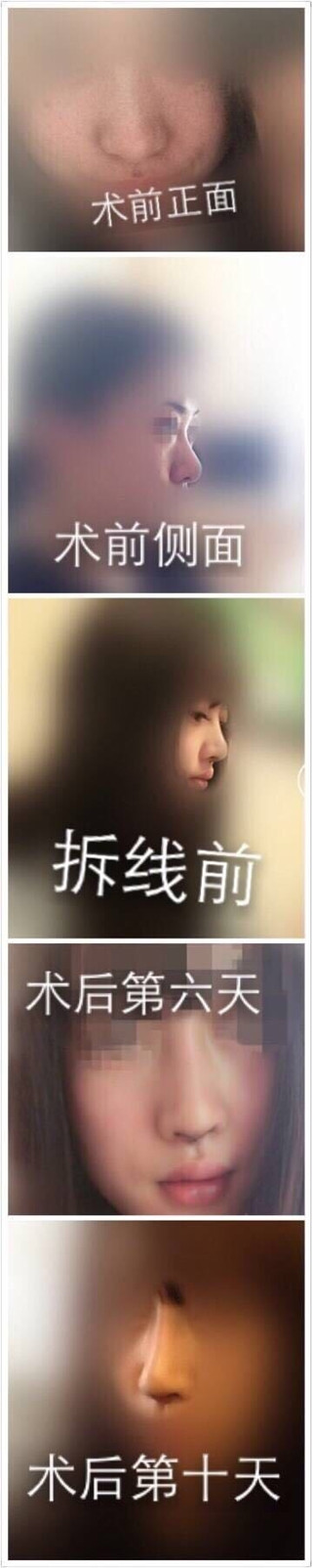 北京罗汇东医生做的鼻部手术整形手术