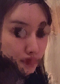 北京罗汇东医生做的鼻部手术整形手术