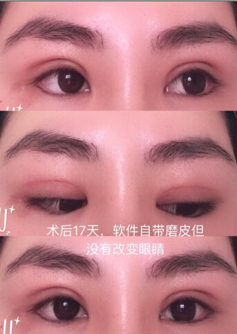 上海九院谢峰医生做的全切双眼皮和鼻子
