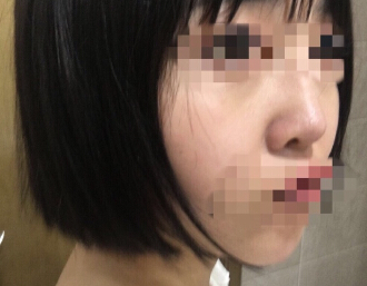 北京壹加壹做的鼻部手术整形手术