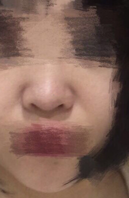 北京壹加壹做的鼻部手术整形手术