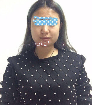 打注射瘦脸会有副作用吗？