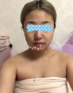打注射瘦脸会有副作用吗？