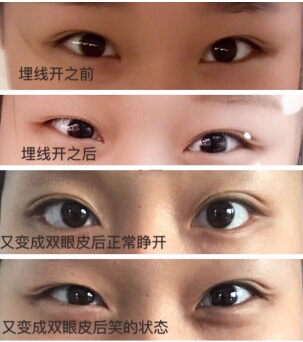 又是埋线双眼皮,是否需要修复?