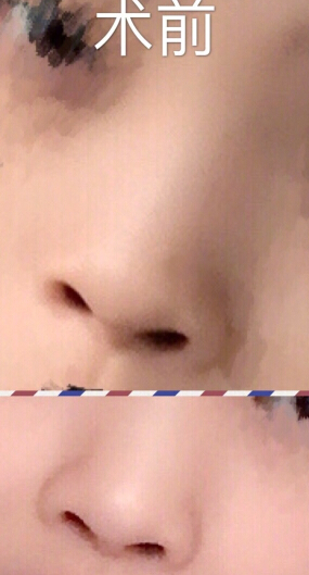 成都娇点李竞医生做的鼻部手术整形手术