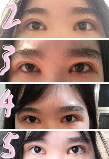 上海伊莱美整形美容医院做的双眼皮开眼角