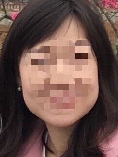 在广州打注射瘦脸果怎么样?